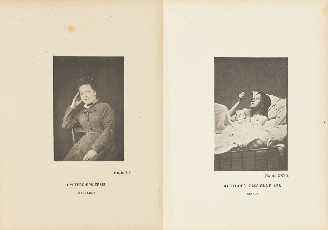 Paul-Marie-Léon Regnard, “Augustine Gleizes, Normal State” and “Augustine Gleizes, Menace,” 1878